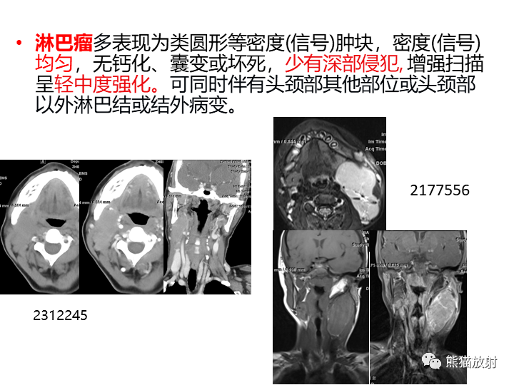影像PPT - 【病例】咽旁多形性腺瘤VS神经鞘瘤-28