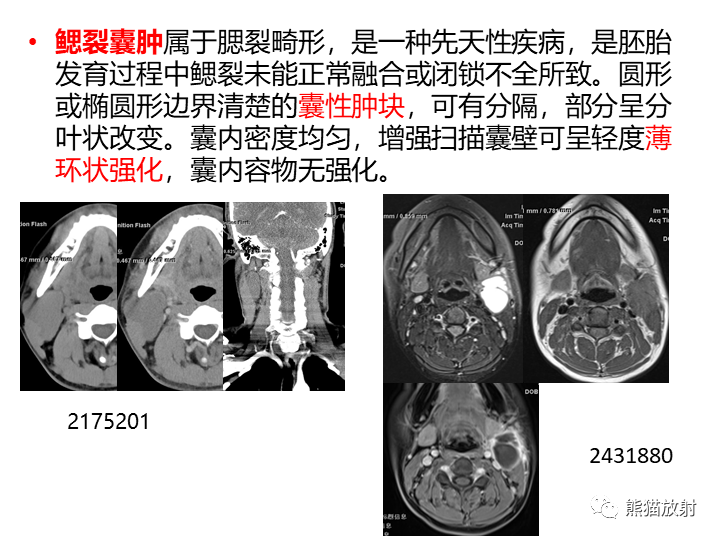 影像PPT - 【病例】咽旁多形性腺瘤VS神经鞘瘤-30