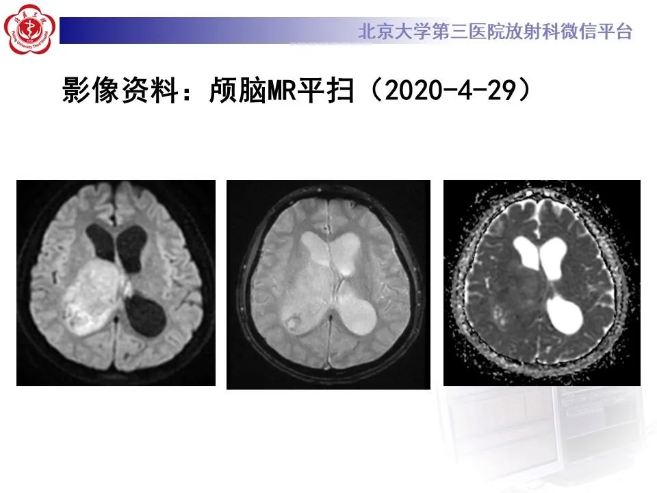 影像PPT - 【病例】弥漫性中线胶质瘤1例CT及MR-4