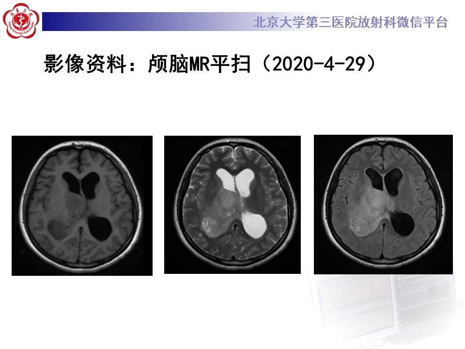 影像PPT - 【病例】弥漫性中线胶质瘤1例CT及MR-3