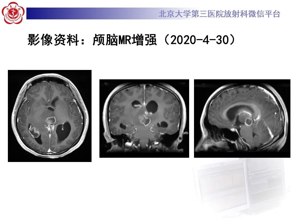 影像PPT - 【病例】弥漫性中线胶质瘤1例CT及MR-5