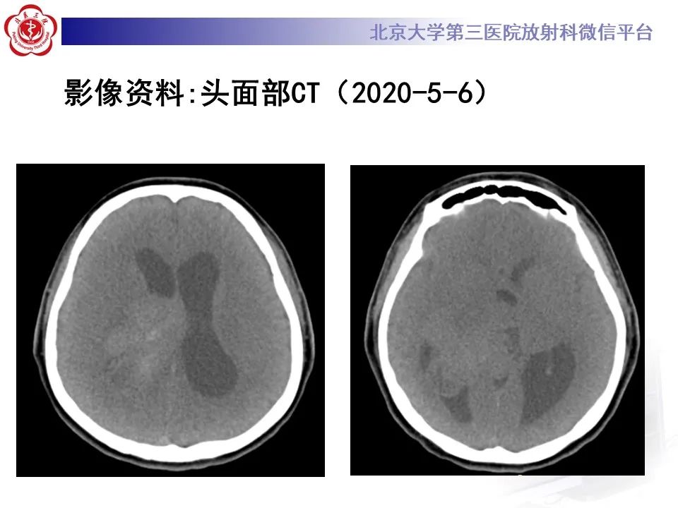 影像PPT - 【病例】弥漫性中线胶质瘤1例CT及MR-6
