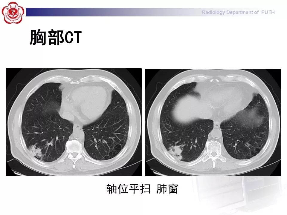 影像PPT - 【PPT】肺黏液表皮样癌（PMEC）影像-3