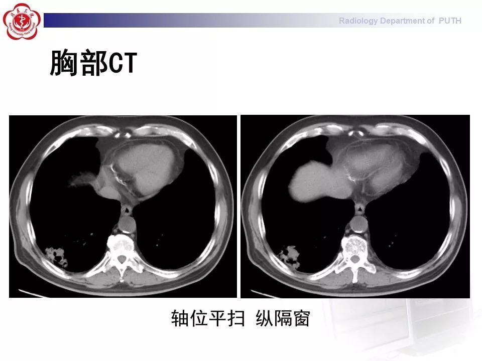 影像PPT - 【PPT】肺黏液表皮样癌（PMEC）影像-4