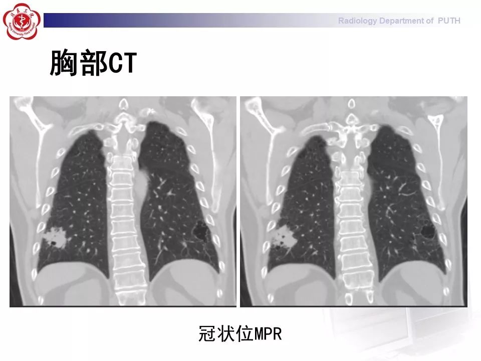 影像PPT - 【PPT】肺黏液表皮样癌（PMEC）影像-5