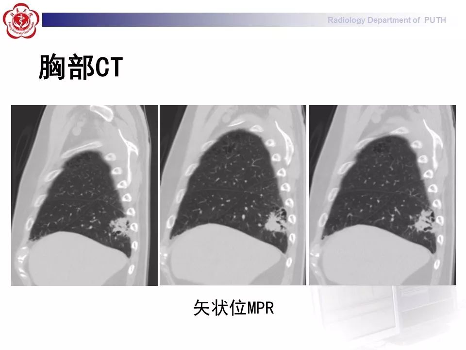 影像PPT - 【PPT】肺黏液表皮样癌（PMEC）影像-6