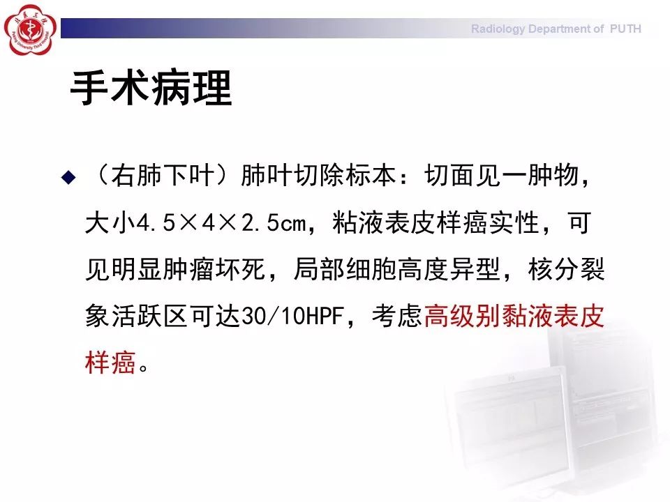 影像PPT - 【PPT】肺黏液表皮样癌（PMEC）影像-8