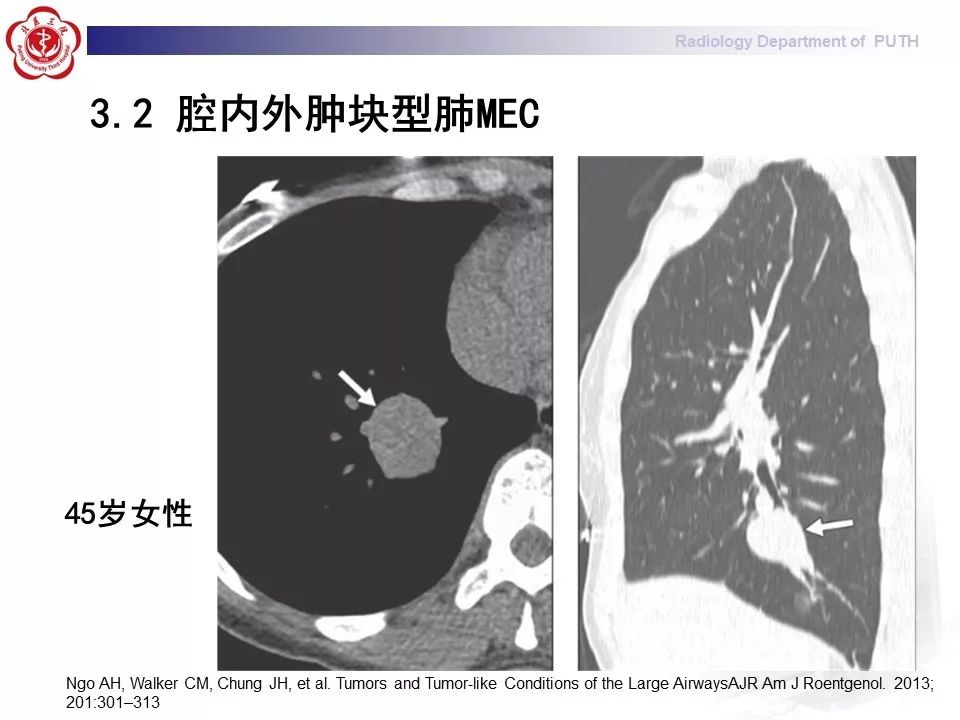 影像PPT - 【PPT】肺黏液表皮样癌（PMEC）影像-23
