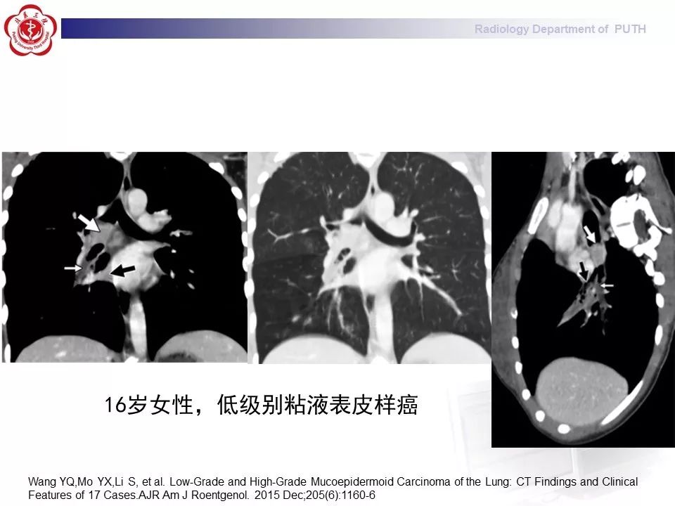 影像PPT - 【PPT】肺黏液表皮样癌（PMEC）影像-21