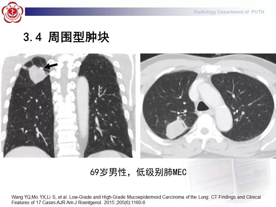 影像PPT - 【PPT】肺黏液表皮样癌（PMEC）影像-26
