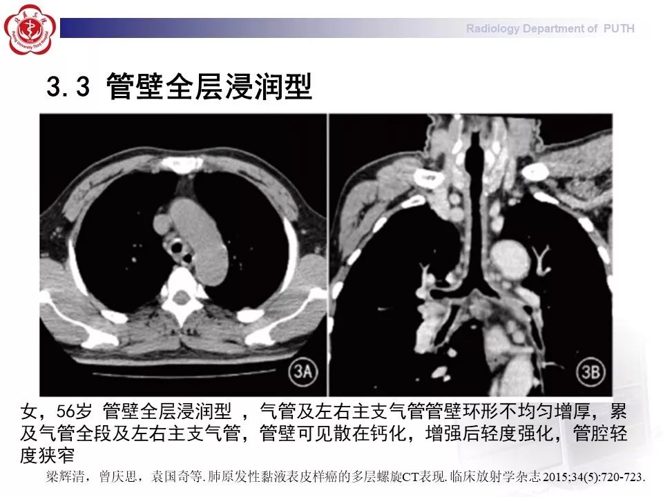 影像PPT - 【PPT】肺黏液表皮样癌（PMEC）影像-25