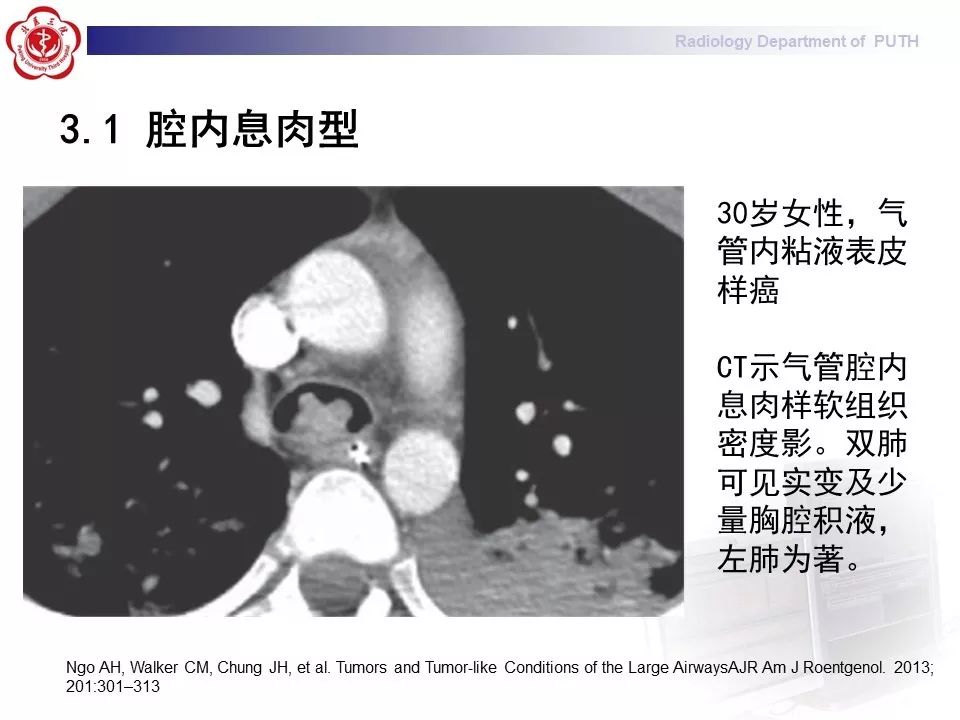 影像PPT - 【PPT】肺黏液表皮样癌（PMEC）影像-20