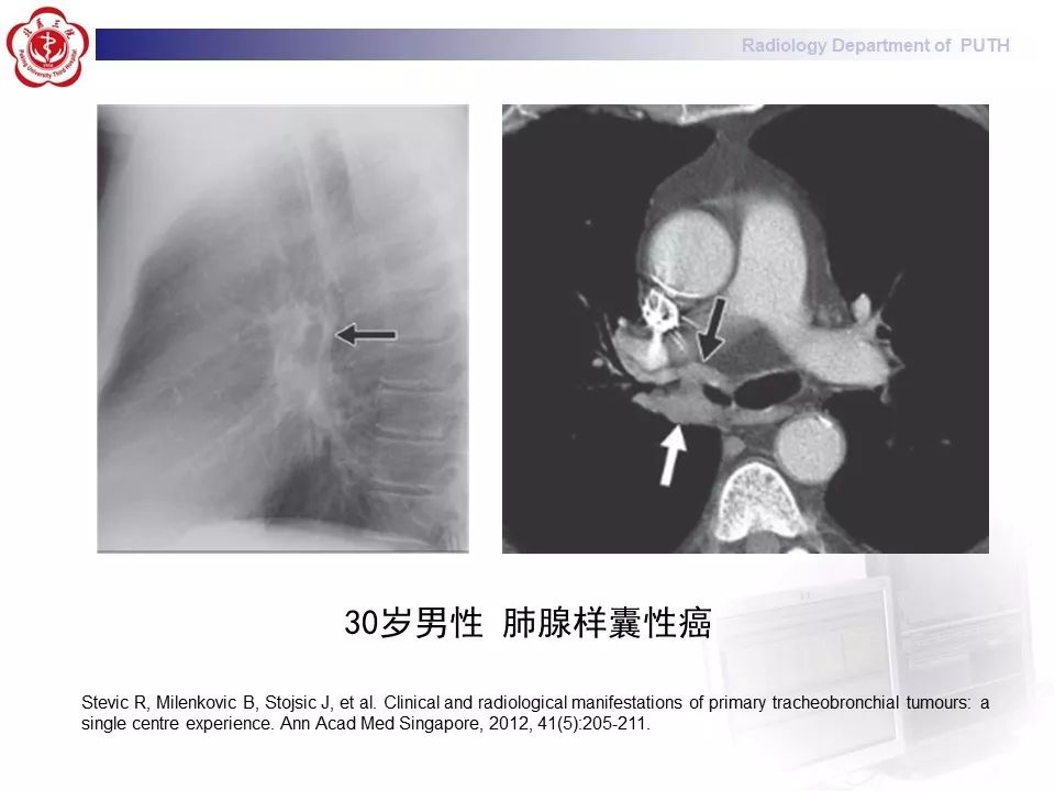 影像PPT - 【PPT】肺黏液表皮样癌（PMEC）影像-29