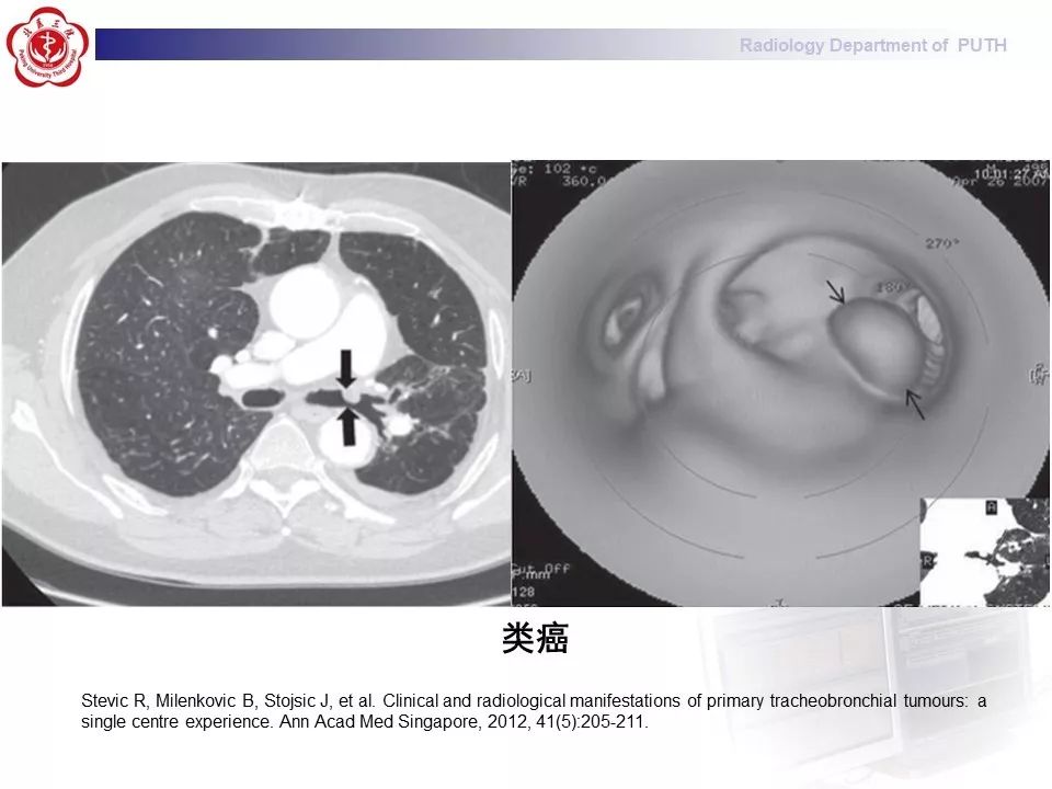 影像PPT - 【PPT】肺黏液表皮样癌（PMEC）影像-31