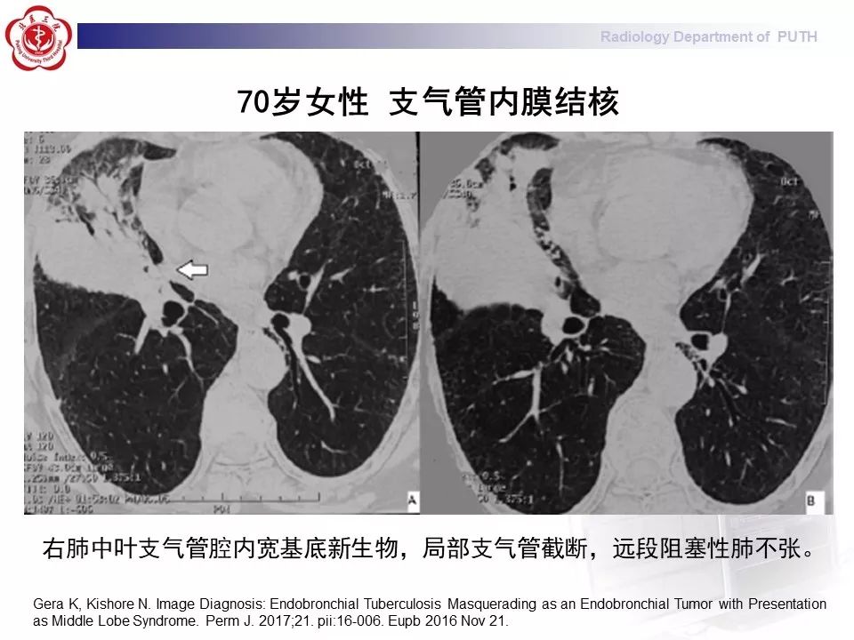 影像PPT - 【PPT】肺黏液表皮样癌（PMEC）影像-35