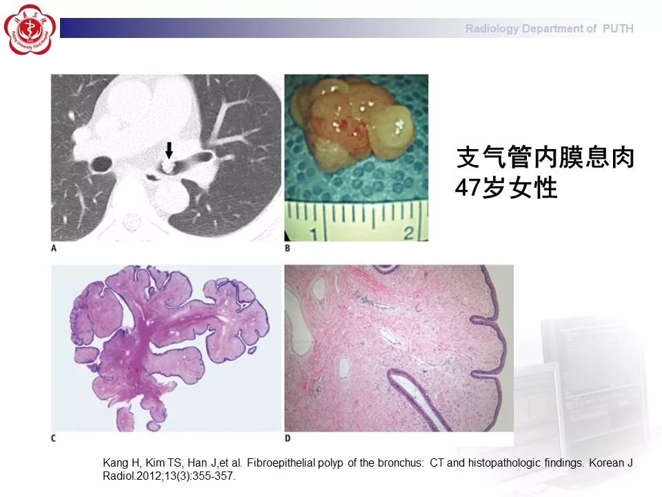 影像PPT - 【PPT】肺黏液表皮样癌（PMEC）影像-33