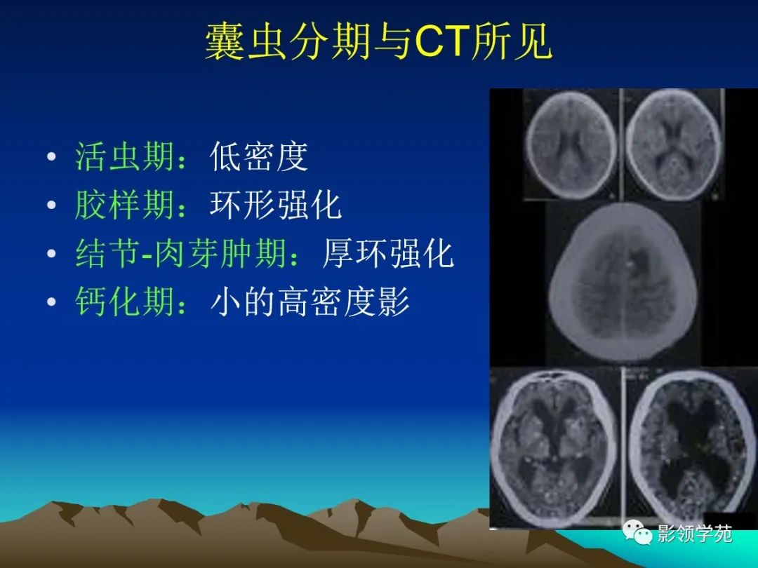 影像PPT - 脑囊虫病的诊断与鉴别-2 影像PPT - 脑囊虫病的诊断与鉴别-2
