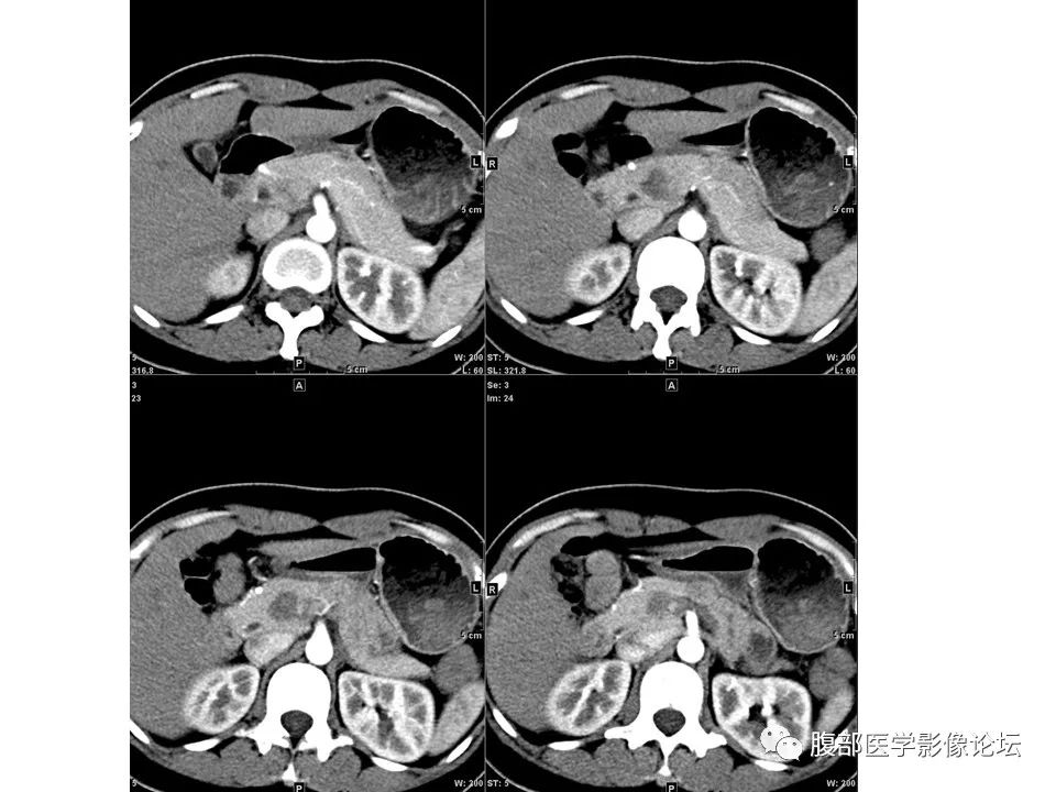 影像PPT - 【病例】胰腺实性假乳头状肿瘤1例CT-4
