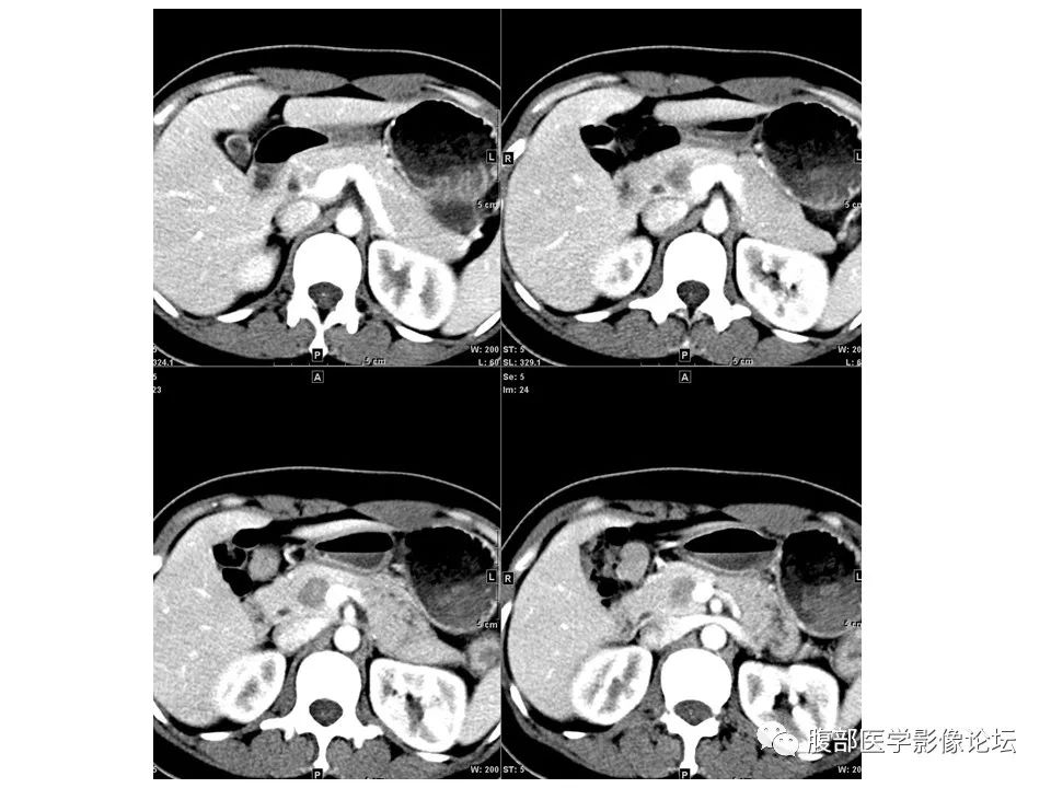 影像PPT - 【病例】胰腺实性假乳头状肿瘤1例CT-5