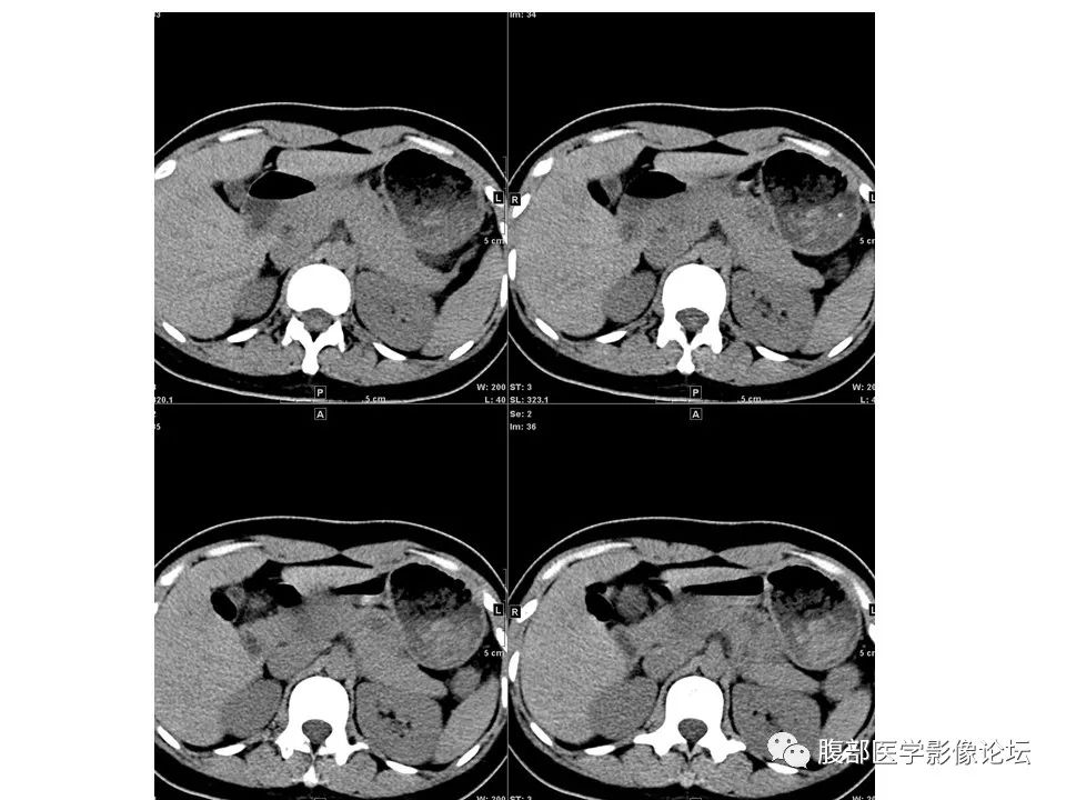 影像PPT - 【病例】胰腺实性假乳头状肿瘤1例CT-3