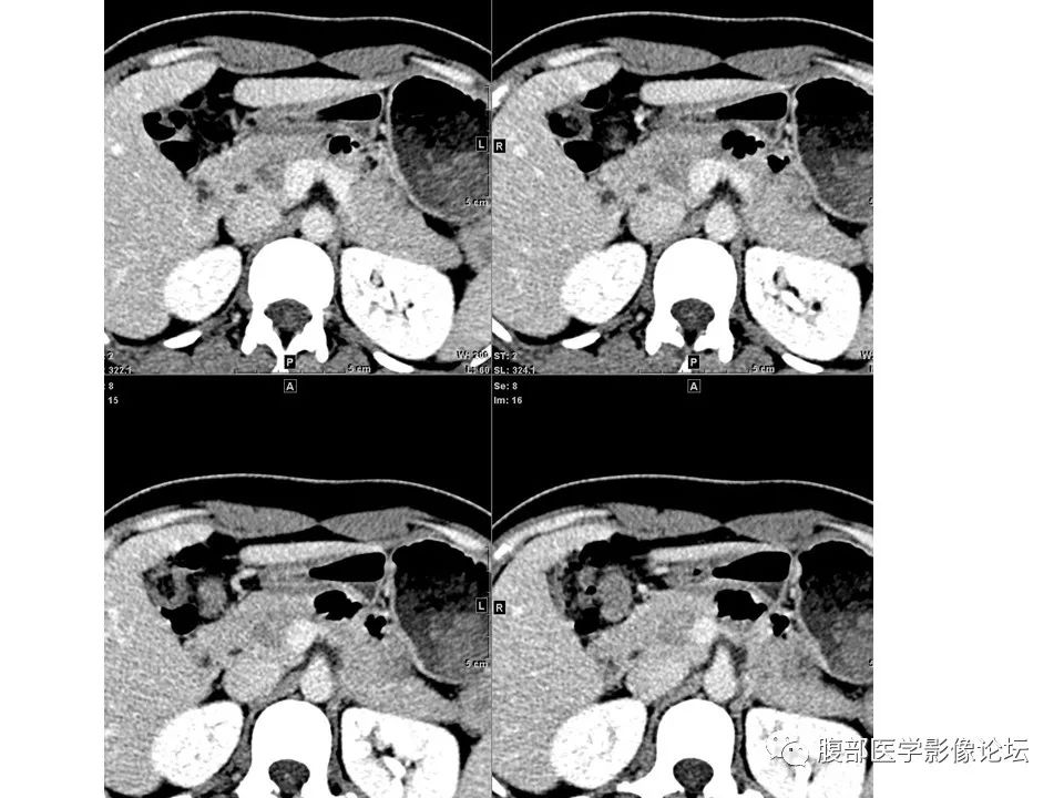 影像PPT - 【病例】胰腺实性假乳头状肿瘤1例CT-7