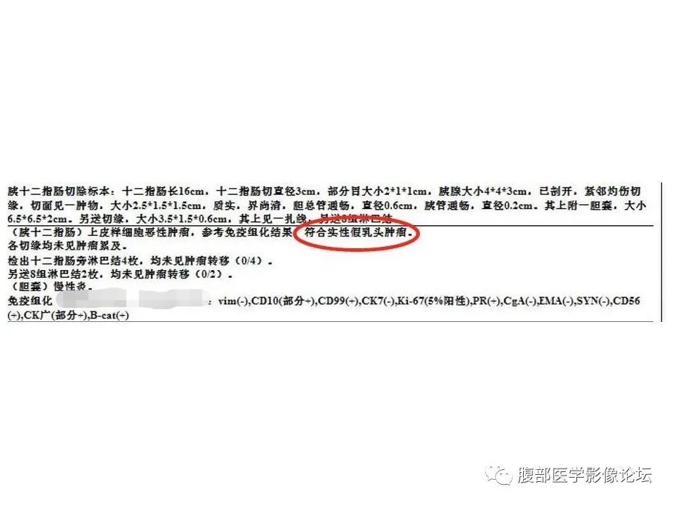 影像PPT - 【病例】胰腺实性假乳头状肿瘤1例CT-8