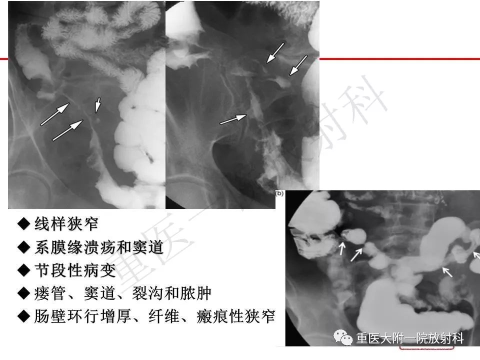 影像PPT - 【PPT】肠道炎性病变的影像诊断-5