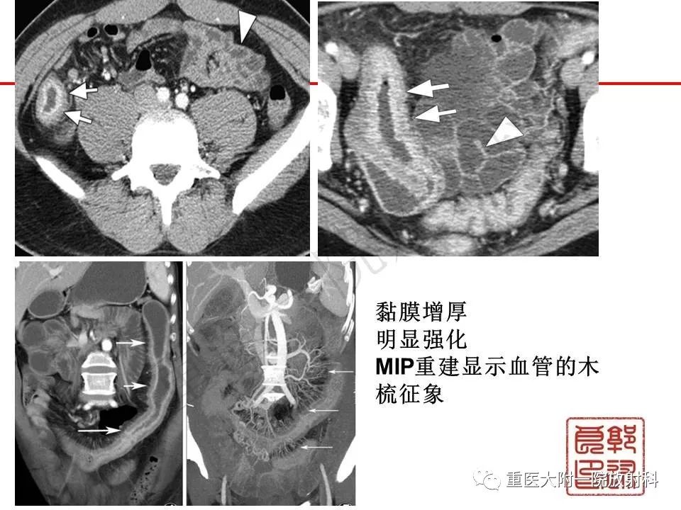 影像PPT - 【PPT】肠道炎性病变的影像诊断-18