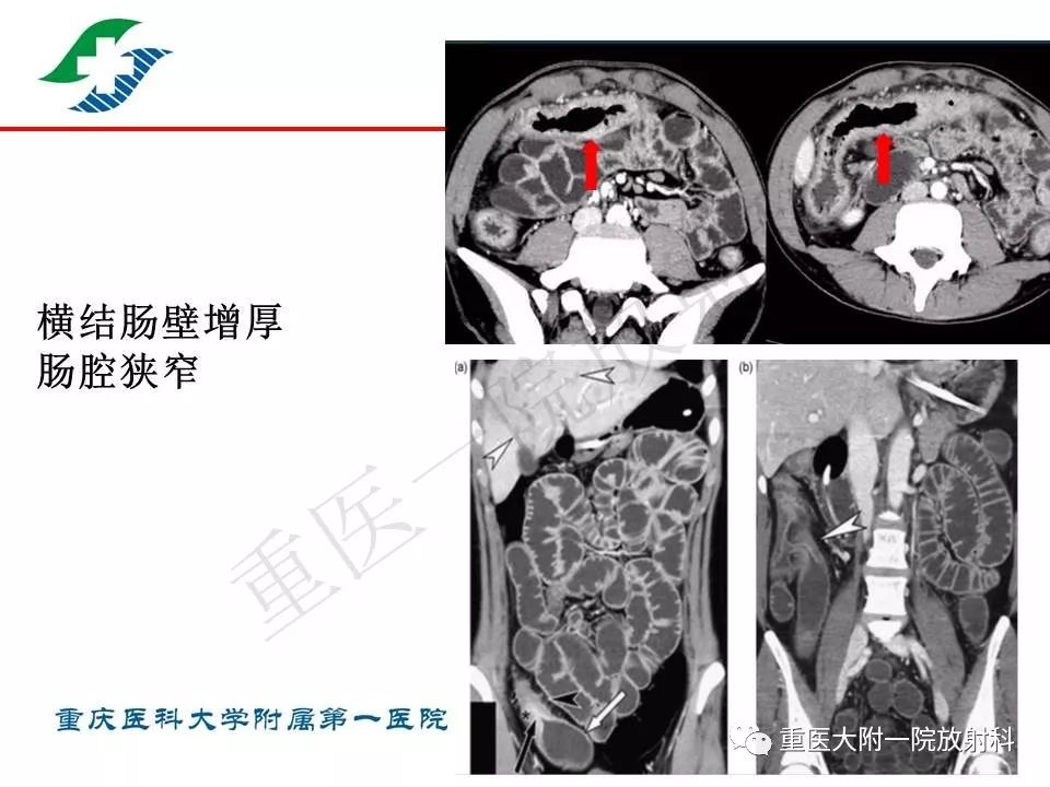 影像PPT - 【PPT】肠道炎性病变的影像诊断-19