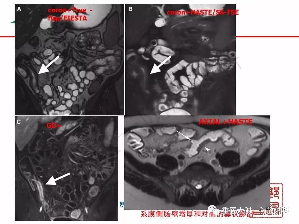 影像PPT - 【PPT】肠道炎性病变的影像诊断-20