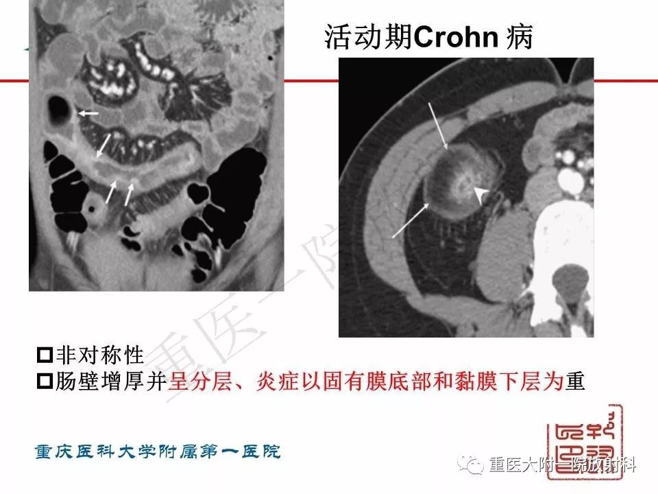 影像PPT - 【PPT】肠道炎性病变的影像诊断-22