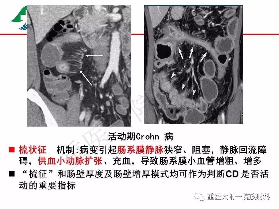 影像PPT - 【PPT】肠道炎性病变的影像诊断-23