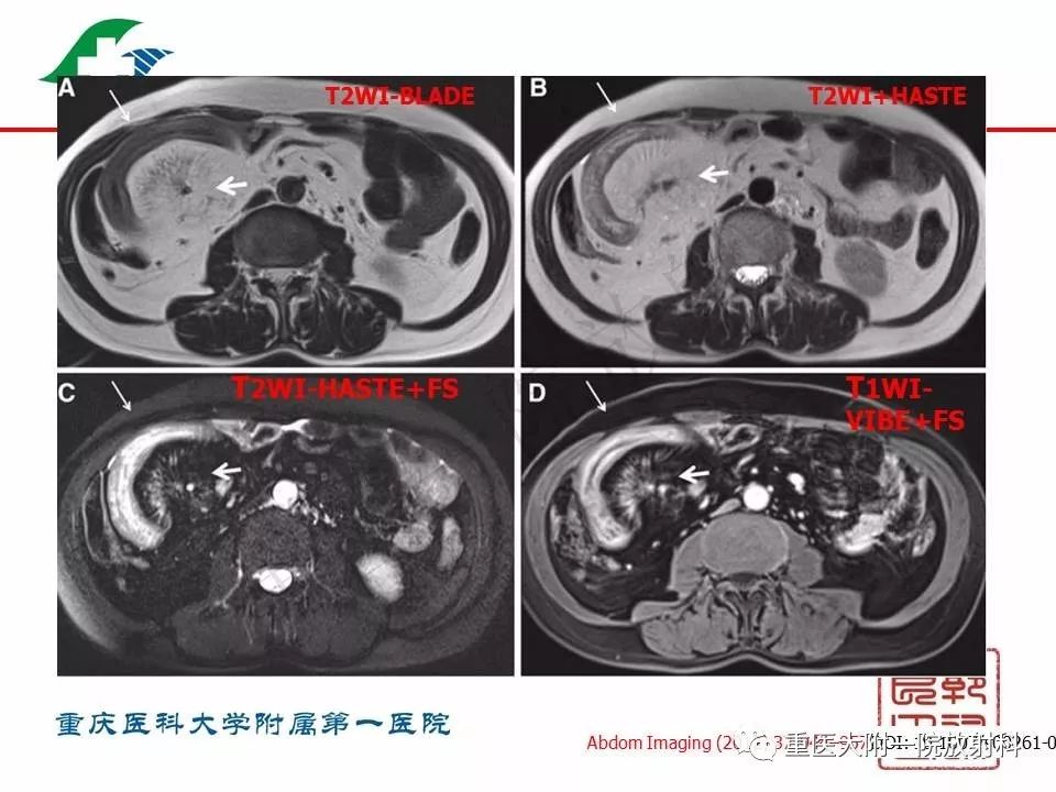 影像PPT - 【PPT】肠道炎性病变的影像诊断-24