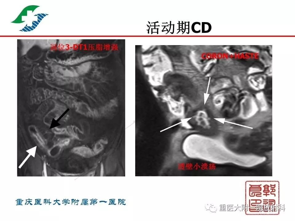 影像PPT - 【PPT】肠道炎性病变的影像诊断-25