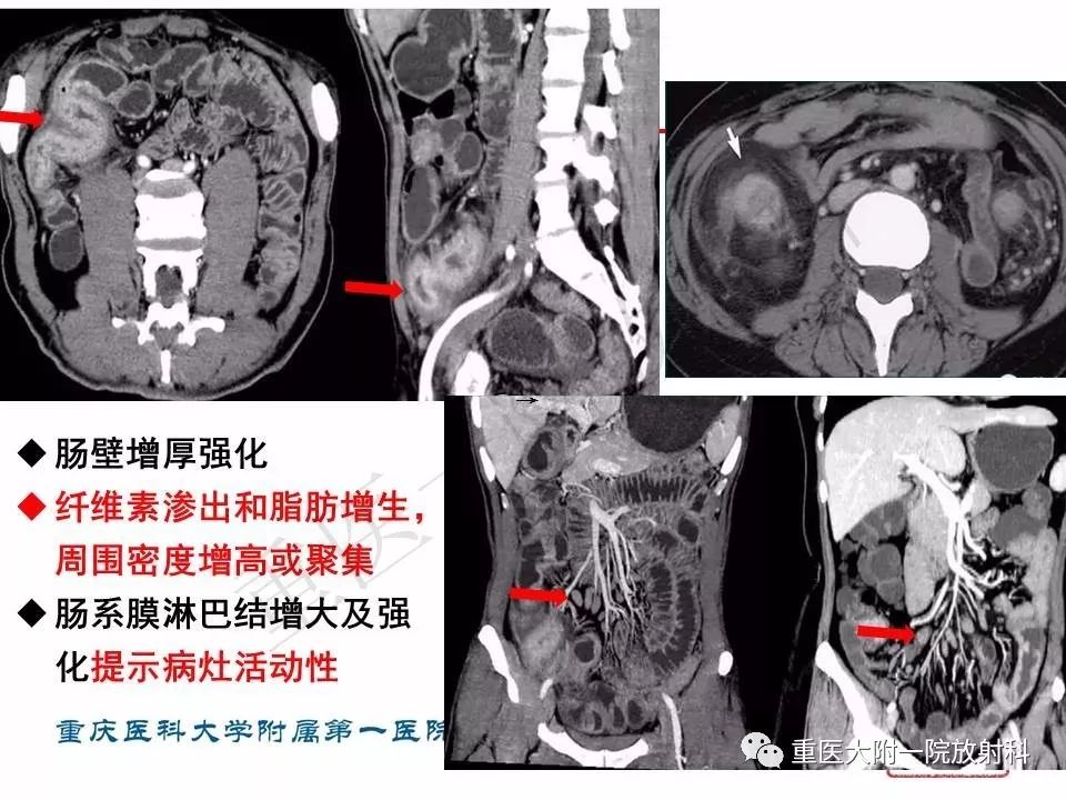 影像PPT - 【PPT】肠道炎性病变的影像诊断-26