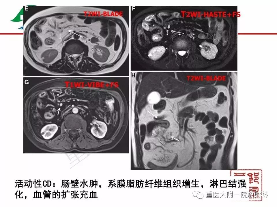 影像PPT - 【PPT】肠道炎性病变的影像诊断-27