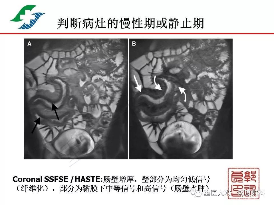 影像PPT - 【PPT】肠道炎性病变的影像诊断-28