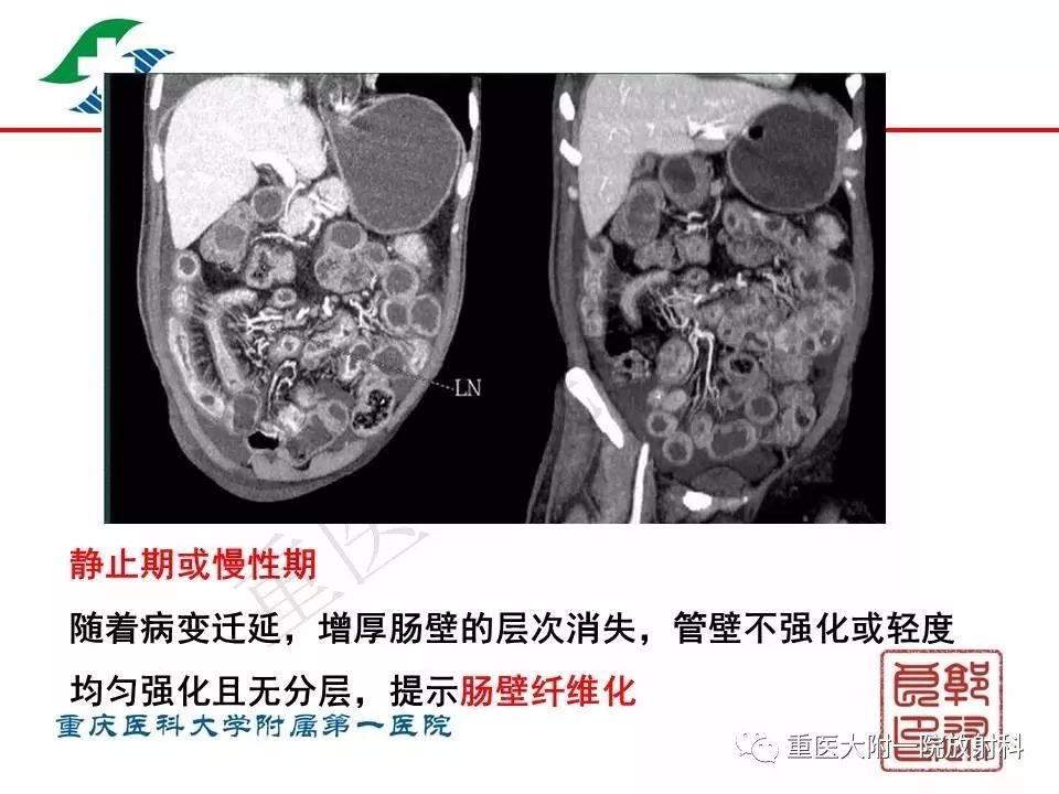 影像PPT - 【PPT】肠道炎性病变的影像诊断-29