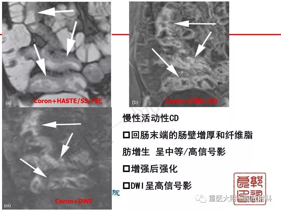 影像PPT - 【PPT】肠道炎性病变的影像诊断-30