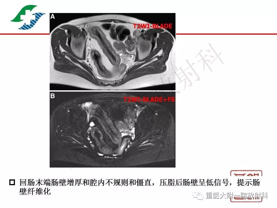 影像PPT - 【PPT】肠道炎性病变的影像诊断-31