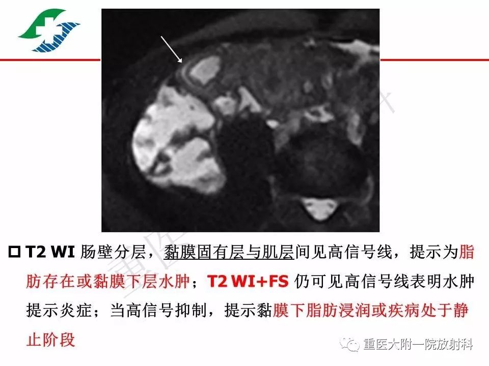 影像PPT - 【PPT】肠道炎性病变的影像诊断-32