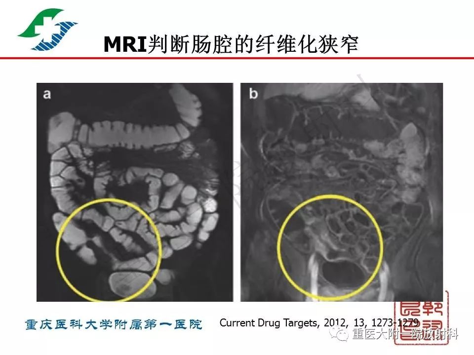影像PPT - 【PPT】肠道炎性病变的影像诊断-33