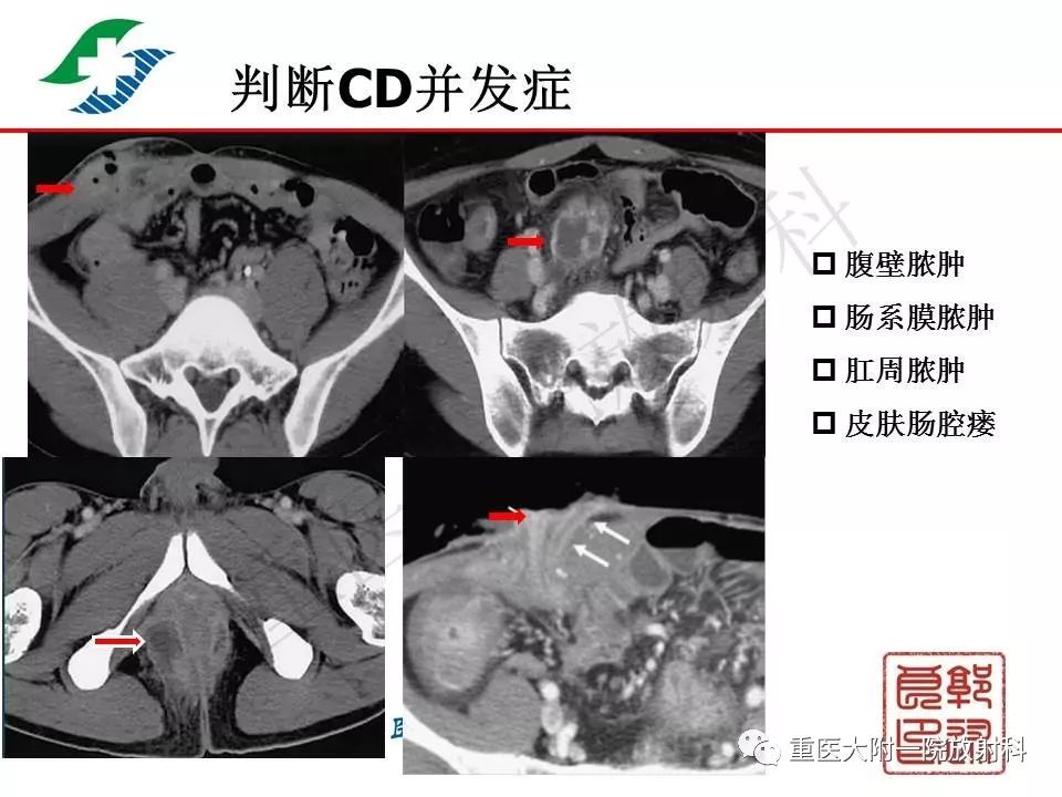 影像PPT - 【PPT】肠道炎性病变的影像诊断-35