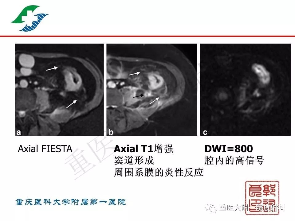 影像PPT - 【PPT】肠道炎性病变的影像诊断-37