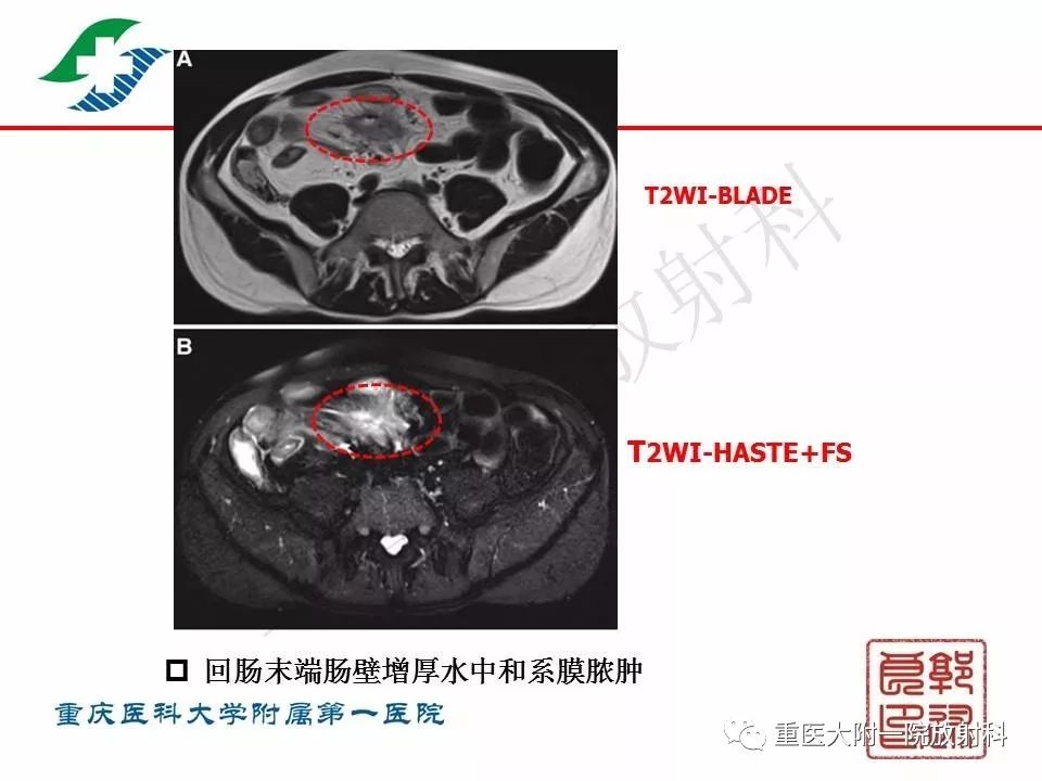 影像PPT - 【PPT】肠道炎性病变的影像诊断-36