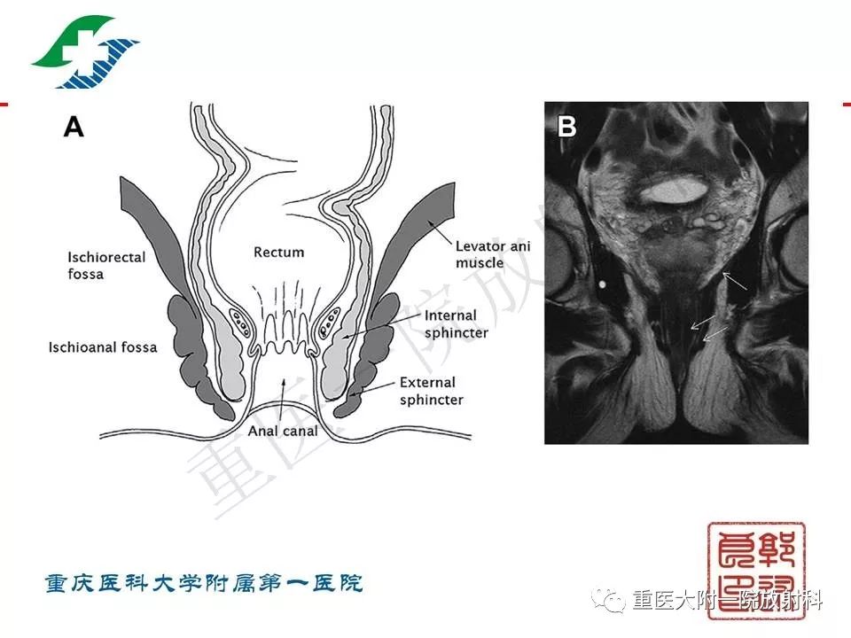 影像PPT - 【PPT】肠道炎性病变的影像诊断-39