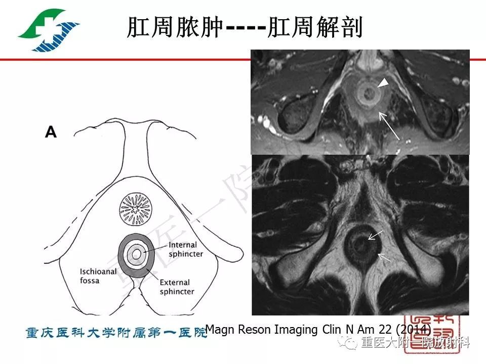 影像PPT - 【PPT】肠道炎性病变的影像诊断-38