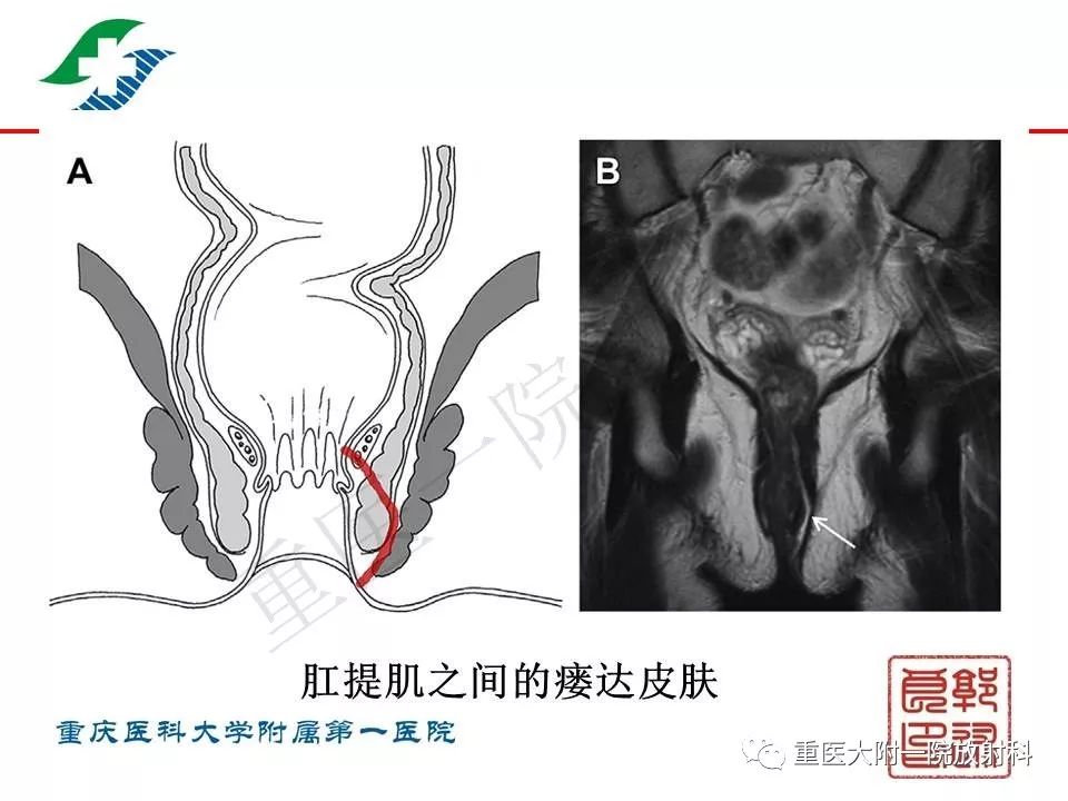 影像PPT - 【PPT】肠道炎性病变的影像诊断-41