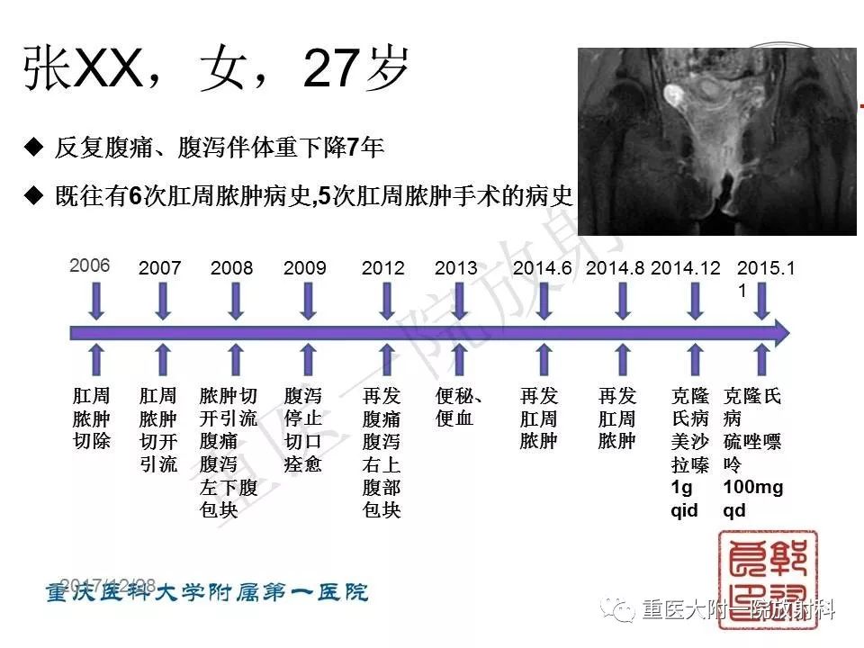 影像PPT - 【PPT】肠道炎性病变的影像诊断-44