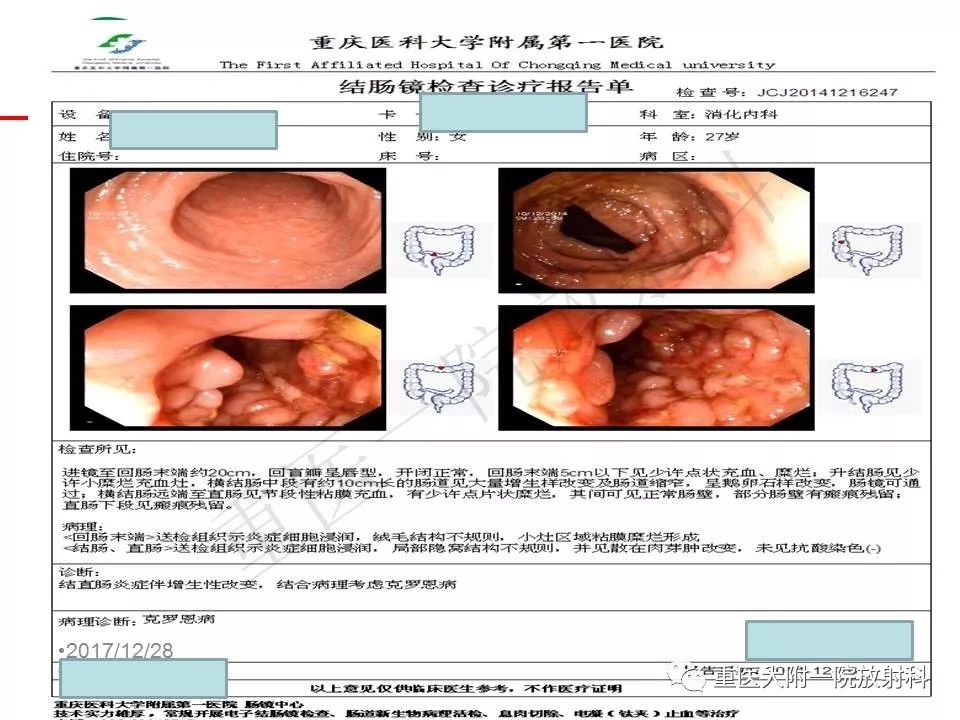 影像PPT - 【PPT】肠道炎性病变的影像诊断-45